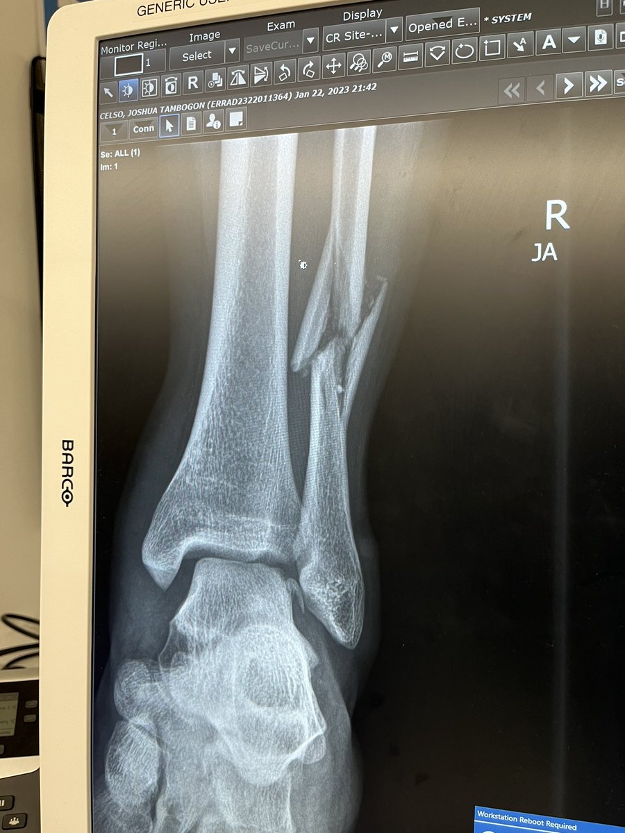 joshcelso's tweet photo. Last night while I was at practice getting ready for a 7v7 tournament in Seattle. I unfortunately broke my ankle while engaging in 1v1s. I’m now at home and resting but now waiting to get surgery! https://t.co/8ZAHD80auw