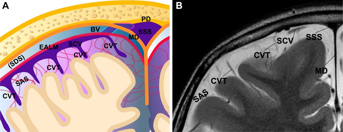 Imaging the Cerebral Veins in Pediatric Patients: Beyond Dural Venous Sinus Thrombosis pubs.rsna.org/doi/10.1148/rg… @RadioGraphics #PediNeuroRad