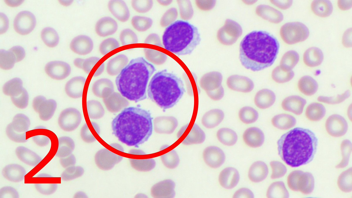 #MorphologyMonday

Lymphocytes can come in all different shapes and sizes. Here are 4. Can you name each and when you may see them.