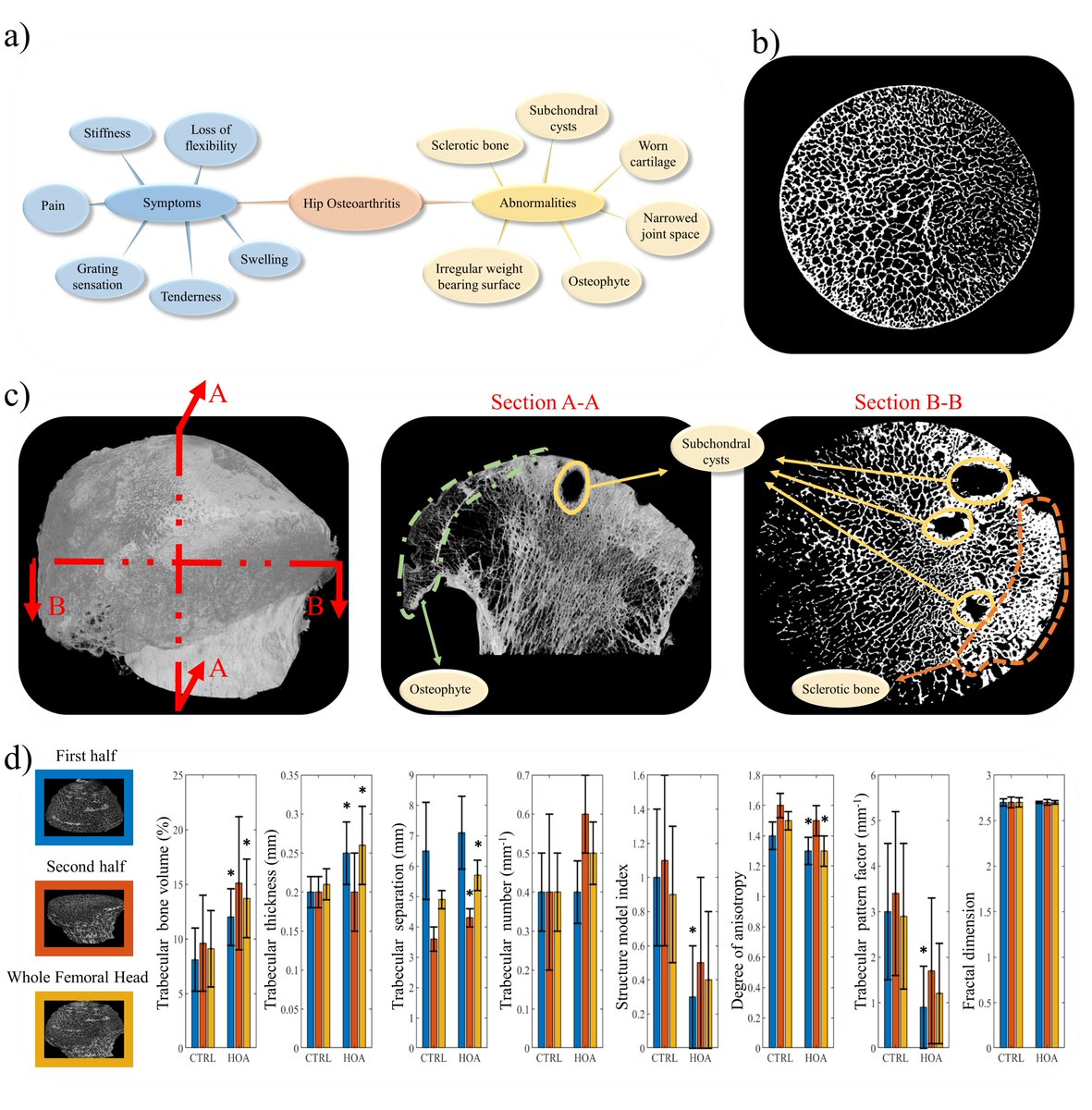 In our latest paper in <a href="/PNASNexus/">PNAS Nexus</a>, we demonstrate how the theory of small world networks can be used to characterize/quantify #osteoarthritis in human bone.
A potential for automating the diagnosis using #machinelearning
<a href="/UniofAdelaide/">Uni of Adelaide</a>, <a href="/sahmriAU/">SAHMRI</a>, <a href="/TheAIML/">Australian Institute for Machine Learning</a>
academic.oup.com/pnasnexus/arti…