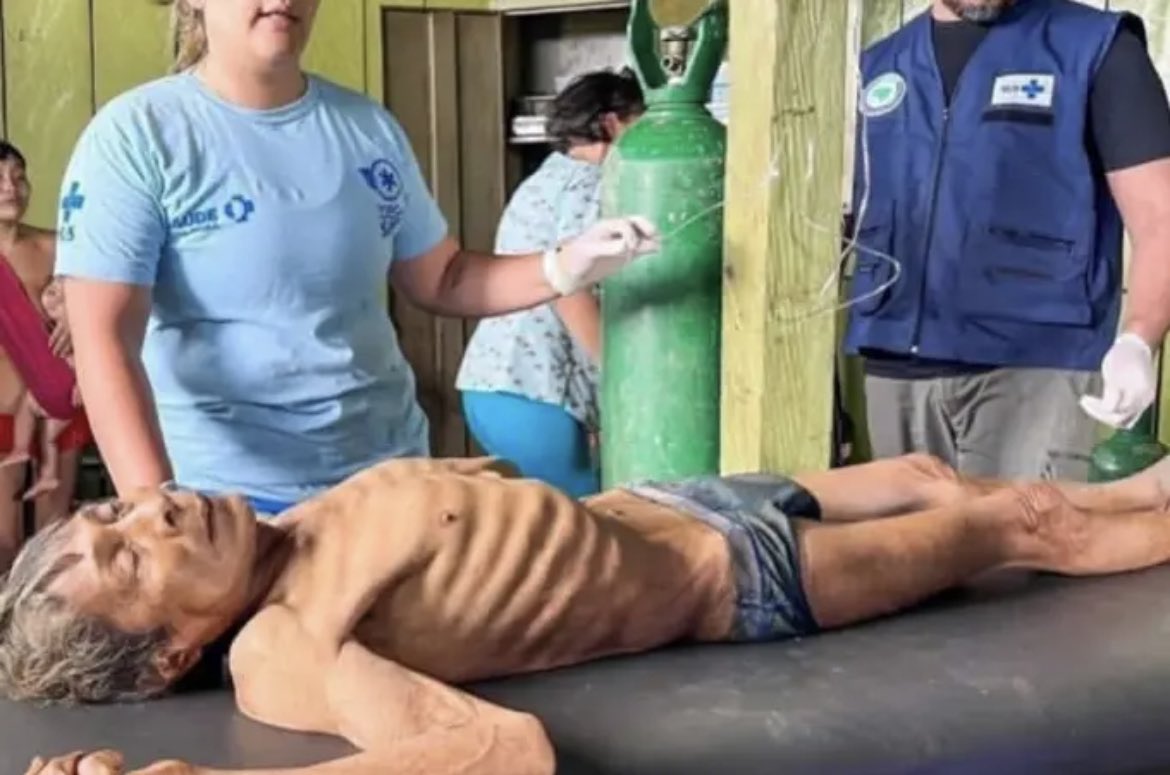 chico_pinheiro's tweet photo. Centenas de Yanomâmis morreram intoxicados por mercúrio de garimpeiros, bandidos de Bolsonaro, morreram de fome, morreram por falta de medicamentos. Não faltaram milhões de comprimidos de cloroquina para “doutor” Jair, nem Viagra para seus oficiais militares. VERGONHA !!! https://t.co/ehI8h6MQjj