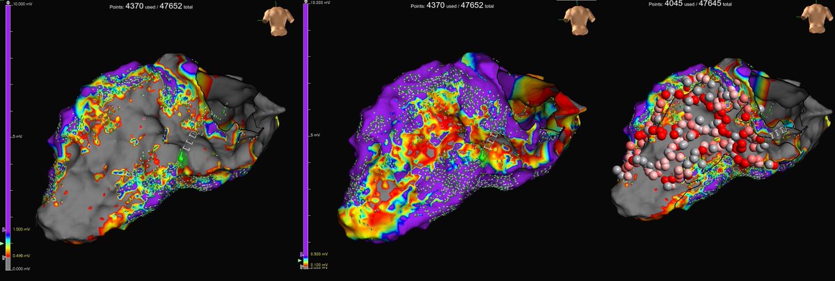 Recent ischemic VT case with large inferior scar... do #EPeeps try changing the voltage below conventional thresholds to visualize potential channels in the scar? Inf VT exit on tele <a href="/WongChrisX/">Chris X Wong</a> <a href="/BoatNoodleSoup/">Adam Lee</a> <a href="/JDMossMD/">Joshua Moss MD</a> <a href="/Ed_Gerst/">Edward Gerstenfeld</a> <a href="/AlexiosHadjis/">Alexios Hadjis</a> <a href="/HHsiaMD/">Henry Hsia</a> <a href="/sanghaimd/">Saket Sanghai MD FACC FHRS</a> <a href="/ArunRSridhar/">Arun Sridhar</a>