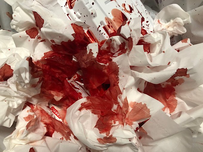 鼻血止まらんくて病院行った 