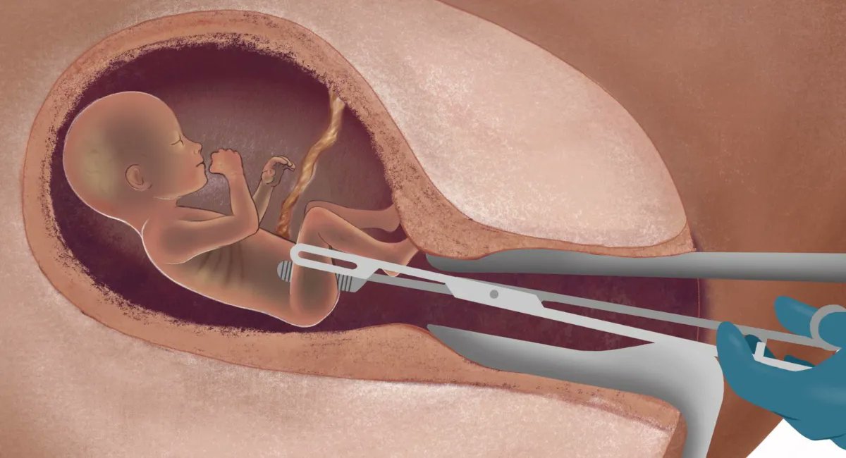 LiveActionNews's tweet image. Abortion doesn’t create ‘beautiful’ lives. It takes them. buff.ly/3H4fJZm