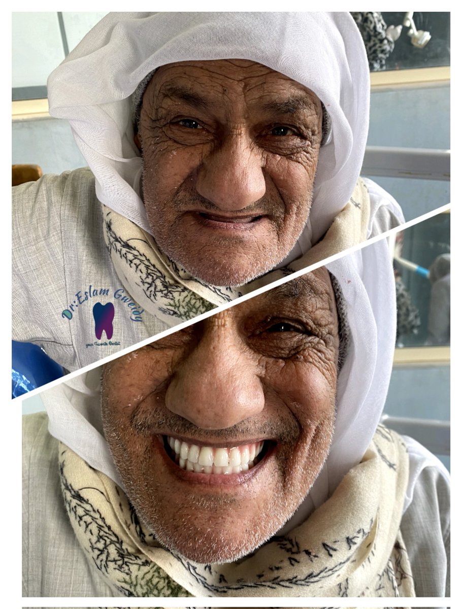EslamGwed's tweet photo. الحمدلله والفضل لله ❤️
أول حالة طقم كامل متحرك ليا 🦷🦷❤️
الحاج محمد كان جاي يعمل طقم علشان يعرف ياكل طلع من عندي بهوليوود سمايل❤️❤️😂😂 https://t.co/xm5d2OdOdt
