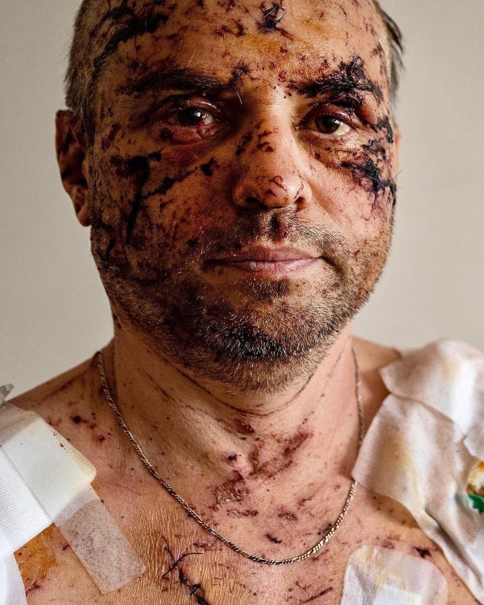 This is Olga Afanasyeva and her husband Oleg Valovyy, photographed in the hospital after the attack in Dnipro.
