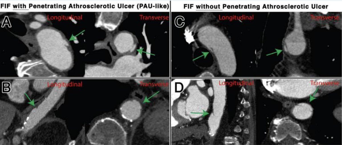 EMERSE was used to search computed tomography angiography (CTA) and magnetic resonance angiography (MRA) reports for terms suggestive of an aortic focal intimal flap (FIF). <a href="/Maasy_Oak/">Austin Maas, MD</a> <a href="/yunahmedumich/">Yunus Ahmed</a> <a href="/BakelPieter/">Pieter van Bakel</a> @nickburrisMD frontiersin.org/articles/10.33…