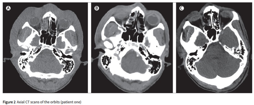 Novel severe oculocutaneous manifestations of human monkeypox virus  infection and their historical analogues - The Lancet Infectious Diseases