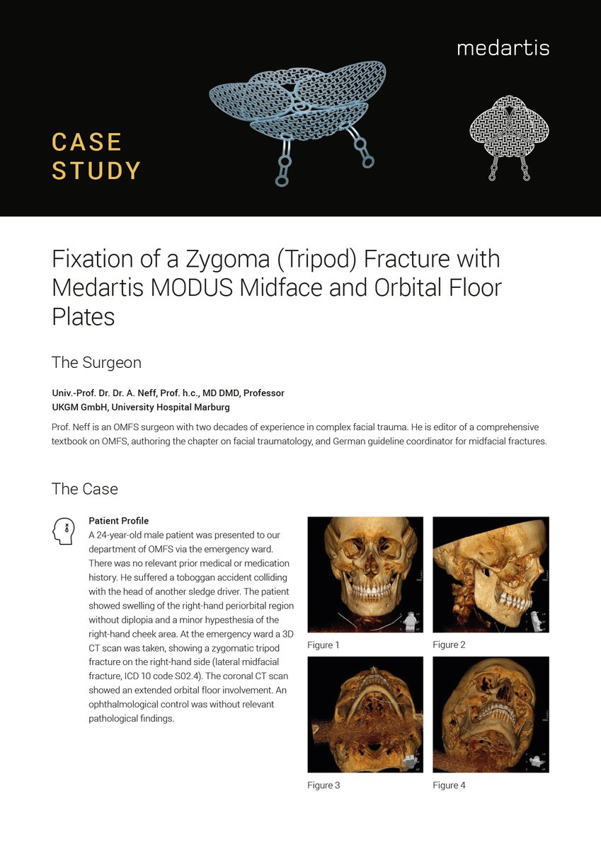 Medartis_Global's tweet image. Read the case study from Prof. A Neff presenting the fixation of a Zygoma (Tripod) Fracture with our MODUS Midface and Orbital Floor Plates. #CMF #MODUS2 #Medartis #surgery #Midface #OPS

⬇️medartis.com/fileadmin/user…

ℹ️​ medartis.com/solutions/deta…