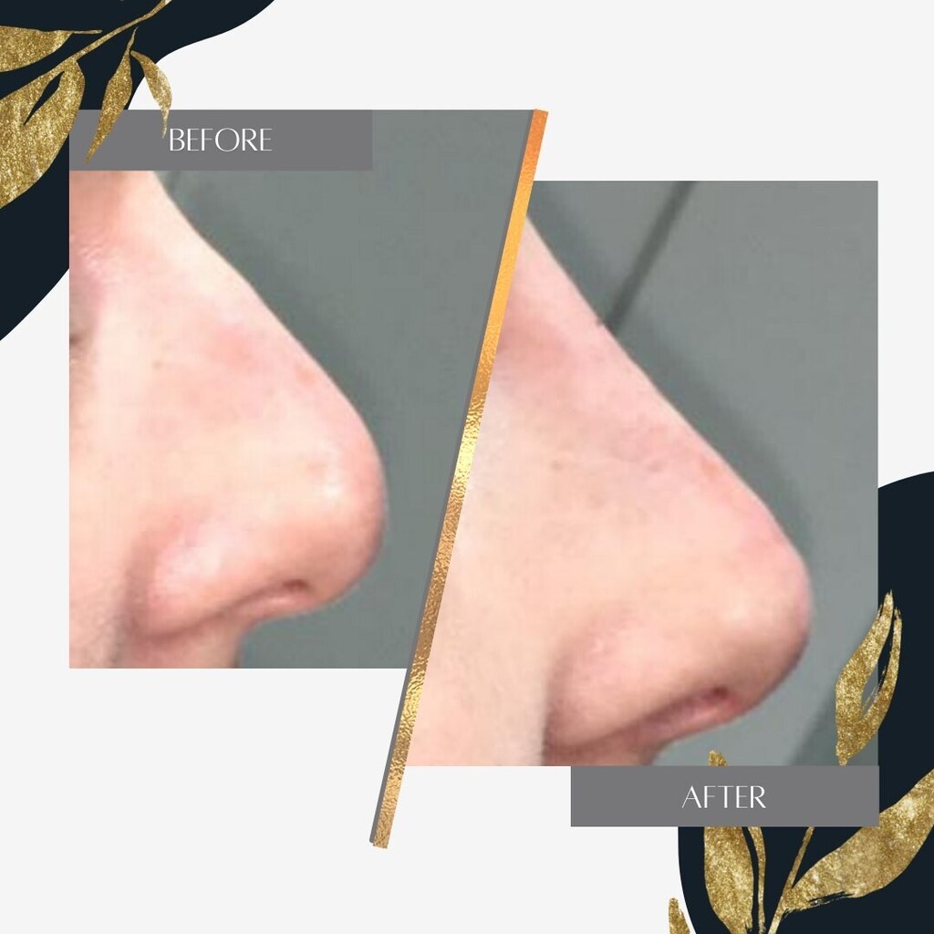 Another beautiful nose transformation in an instant, with zero down time! 
Unfortunately this client had previously had a surgical nose job but was left unhappy with the results, our Aesthetics Experts were thrilled to be able to give her the nose she ha… instagr.am/p/Cnz39bSIZU_/