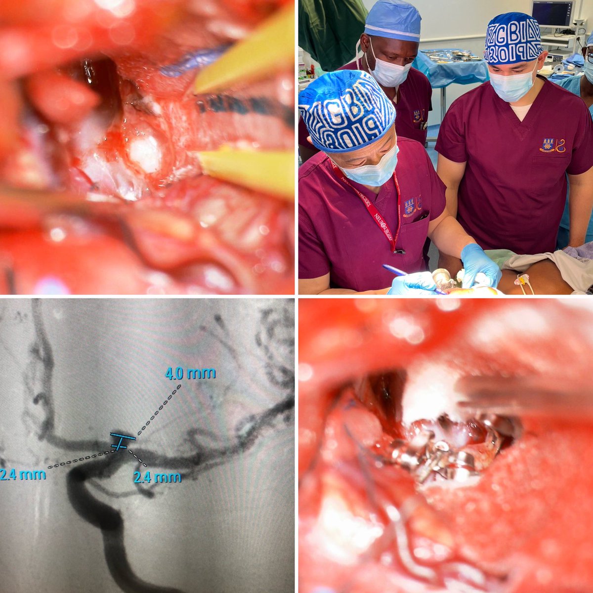 DrWalterJean's tweet photo. Day 2 @globalbrainsurg mission #Ghana: first #aneurysm clipped in🇬🇭 during the microscopic era! One aneurysm at a time is just the beginning! Attention must be paid #awareness @BAFOUND @FIENEUROSURGERY @MGUHNeurosurg @LVHNeuroscience @cvsection @i_amNanaKojo @BonsrahNancy https://t.co/wDD9VrJNxc