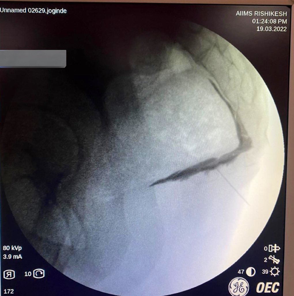 @KalavaMd We did  similar block 7 months back patient is pain free till date 😊<a href="/tolgaergonenc/">Tolga Ergönenç, MD</a> <a href="/NarouzeMD/">Samer Narouze,MD,PhD,MMM</a> <a href="/DrRajSahoo/">Dr Rajendra Sahoo</a> <a href="/tsmurali/">Murali Thondebhavi</a> <a href="/doctdeer/">Tim Deer</a> <a href="/KalagaraHari/">🩺 Hari (హరి 🇮🇳) Kalagara</a> <a href="/jeffgadsden/">Jeff Gadsden</a> <a href="/IASPpain/">IASP</a> <a href="/EFIC_org/">European Pain Federation EFIC®</a>