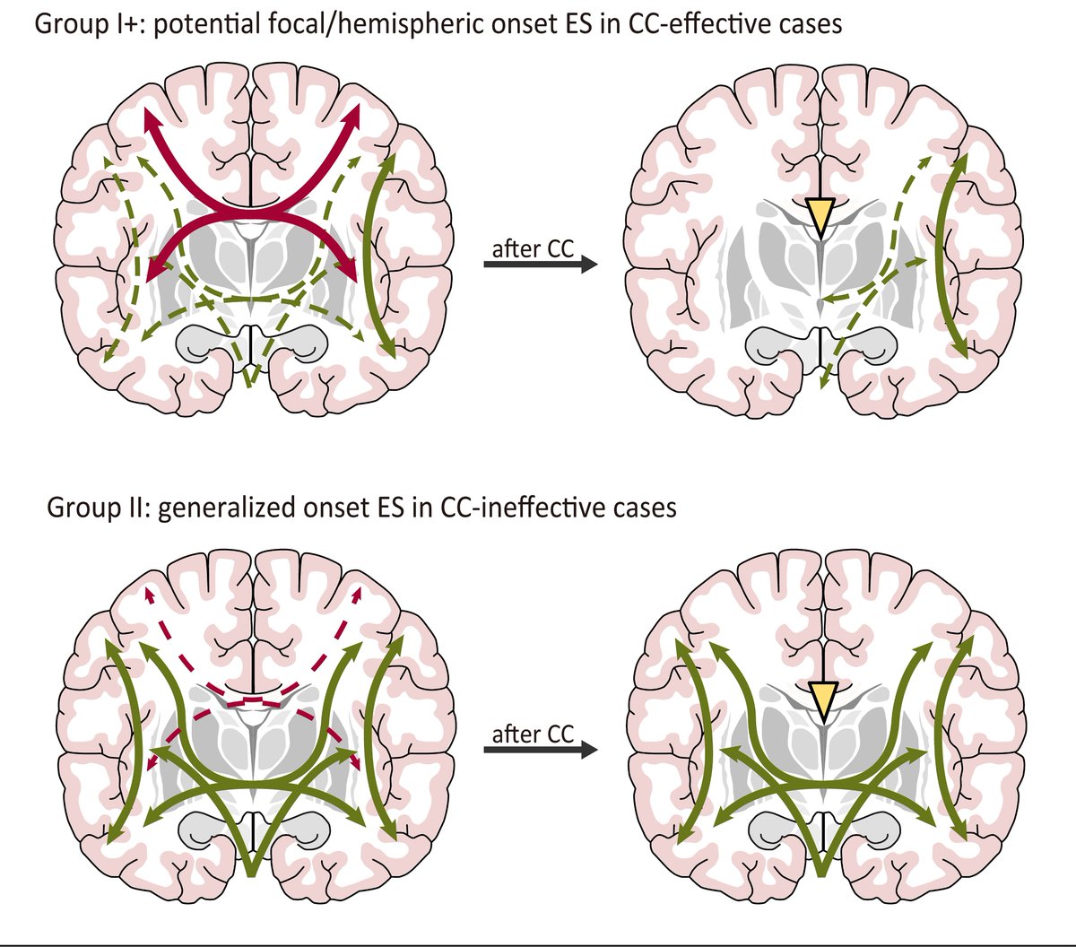 Comparing late‐onset epileptic spasm outcomes after corpus callosotomy and subsequent disconnection surgery between post‐encephalitis/encephalopathy and non‐encephalitis/encephalopathy onlinelibrary.wiley.com/doi/10.1002/ep… 

#epilepsy #ILAE #epilepticspasm  #corpuscallosotomy @WileyNeuro