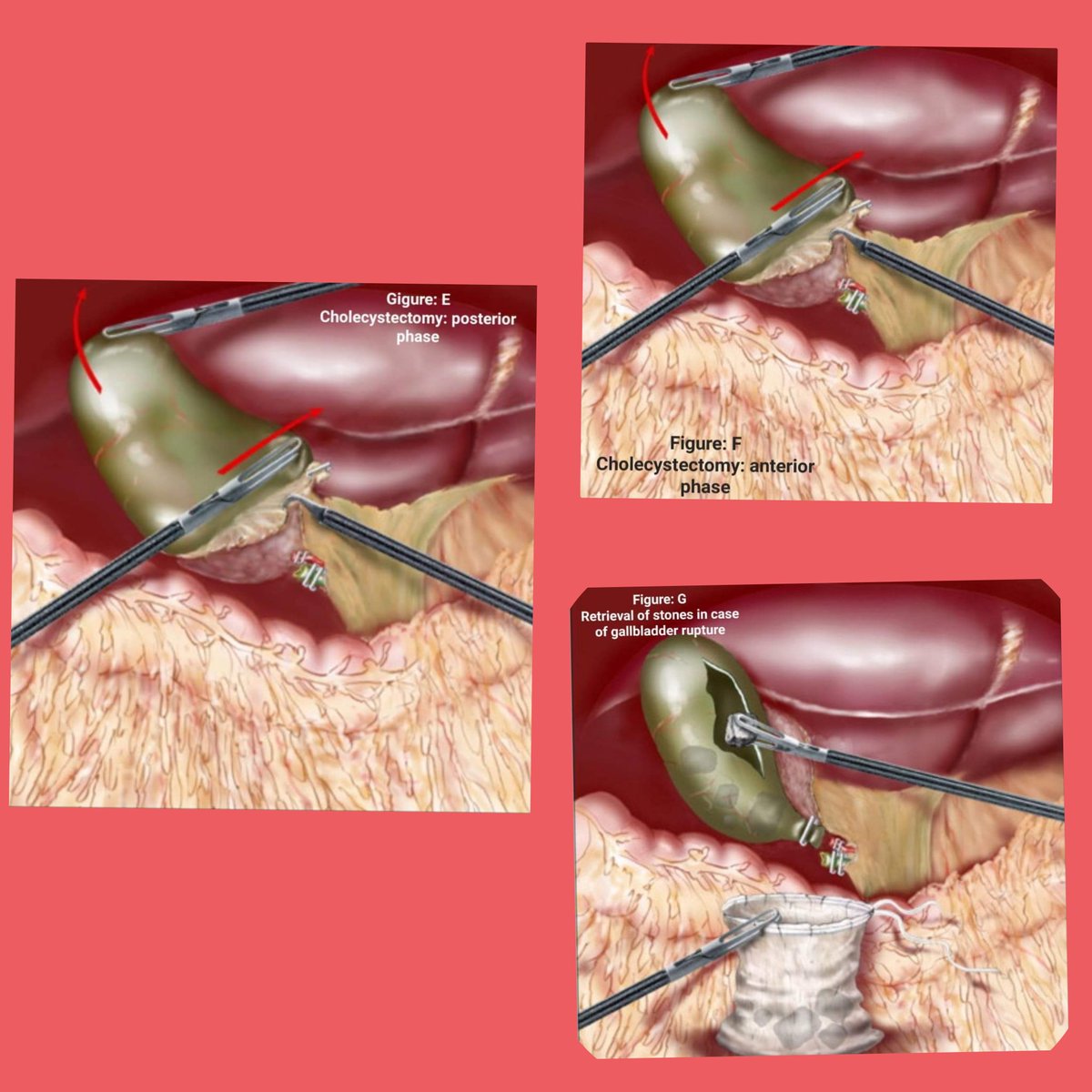 DR AFTAB AHMED on Twitter "Anterior & Posterior Exposure of the