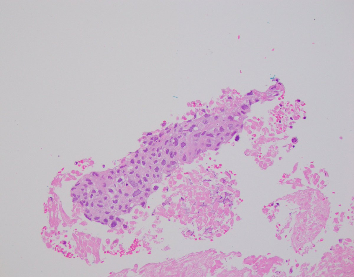 28 year old, no prior HX, presenting with neck lymphadenopathy: CK, p40, GATA3 positive. p16 negative.

What diagnosis are you favoring?

#pathology #surgpath #pathres #GUPATH #HeadandneckPath