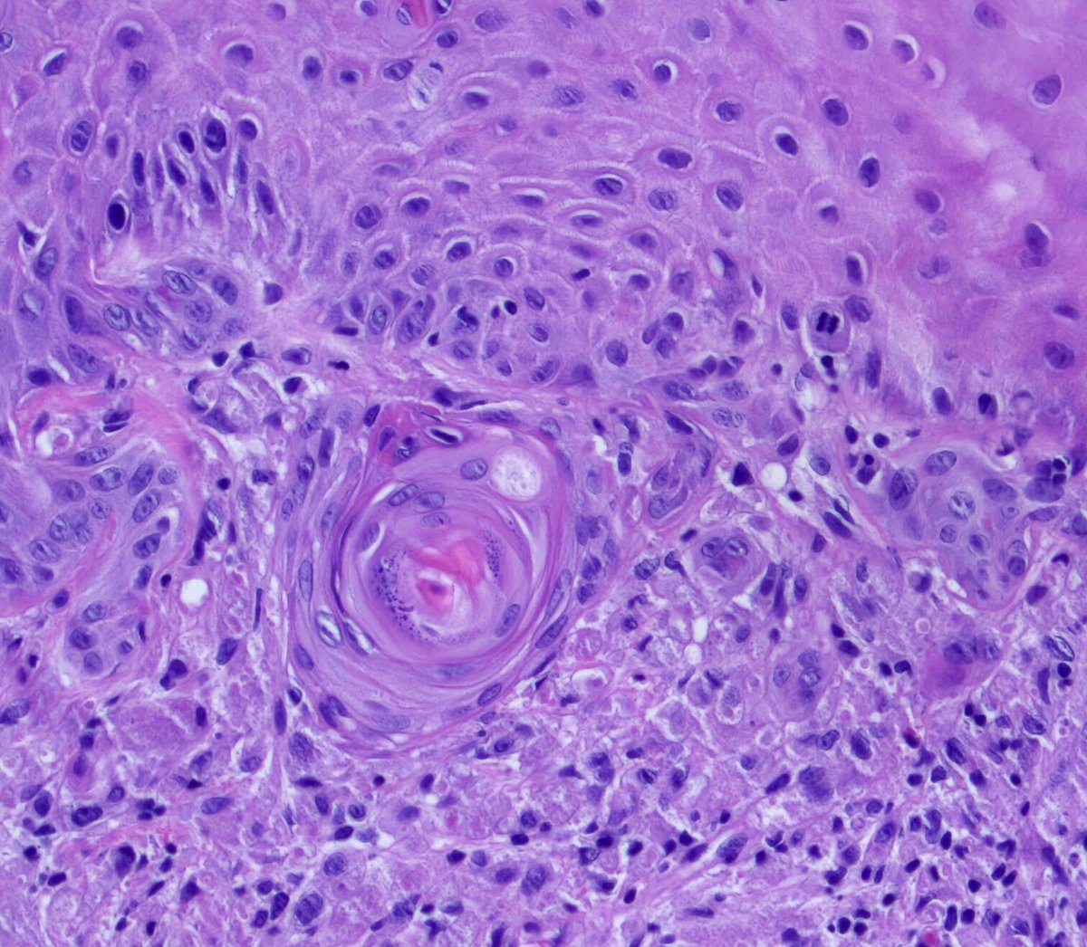 #ENTpath #Pathresidents #Surgpath #Pathtwitter 52 Year old man, hx of tobacco use and leukoplakia, presents with a tongue lesion. How far do you want to go? Poll in reply.