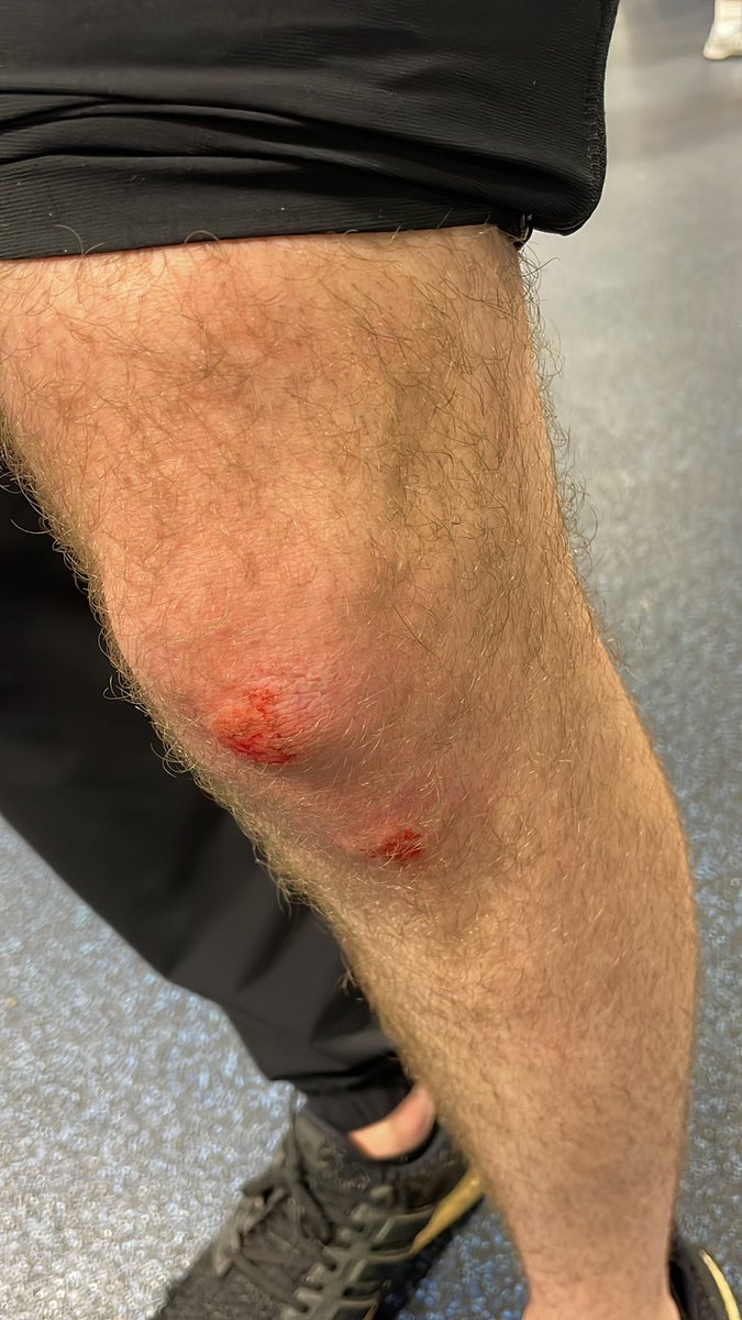 GoardLuke's tweet image. @UofOklahoma my friend Carson Nash stepped outside and slipped on the ice and we have class tomorrow????