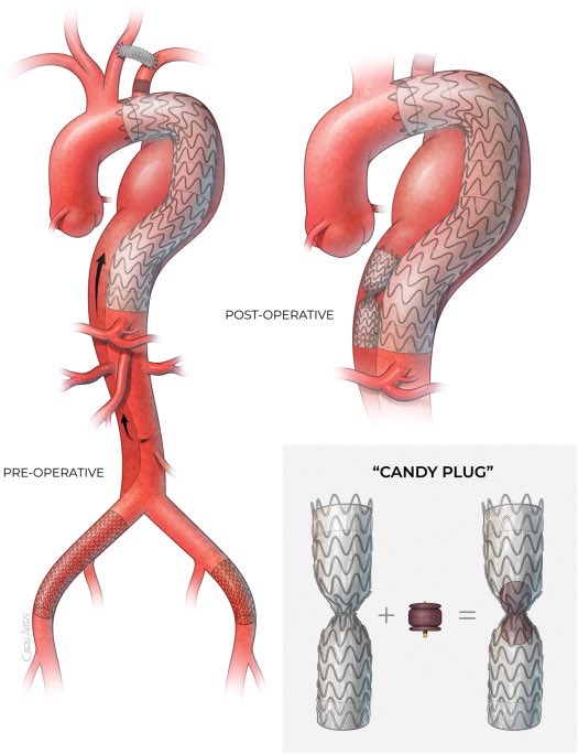 Our modified Candy Plug (CP) uses an off-the-shelf device to address false lumen (FL) perfusion after TEVAR for type B #AorticDissection (TBAD). #JVSCITTweetChat #AortaEd