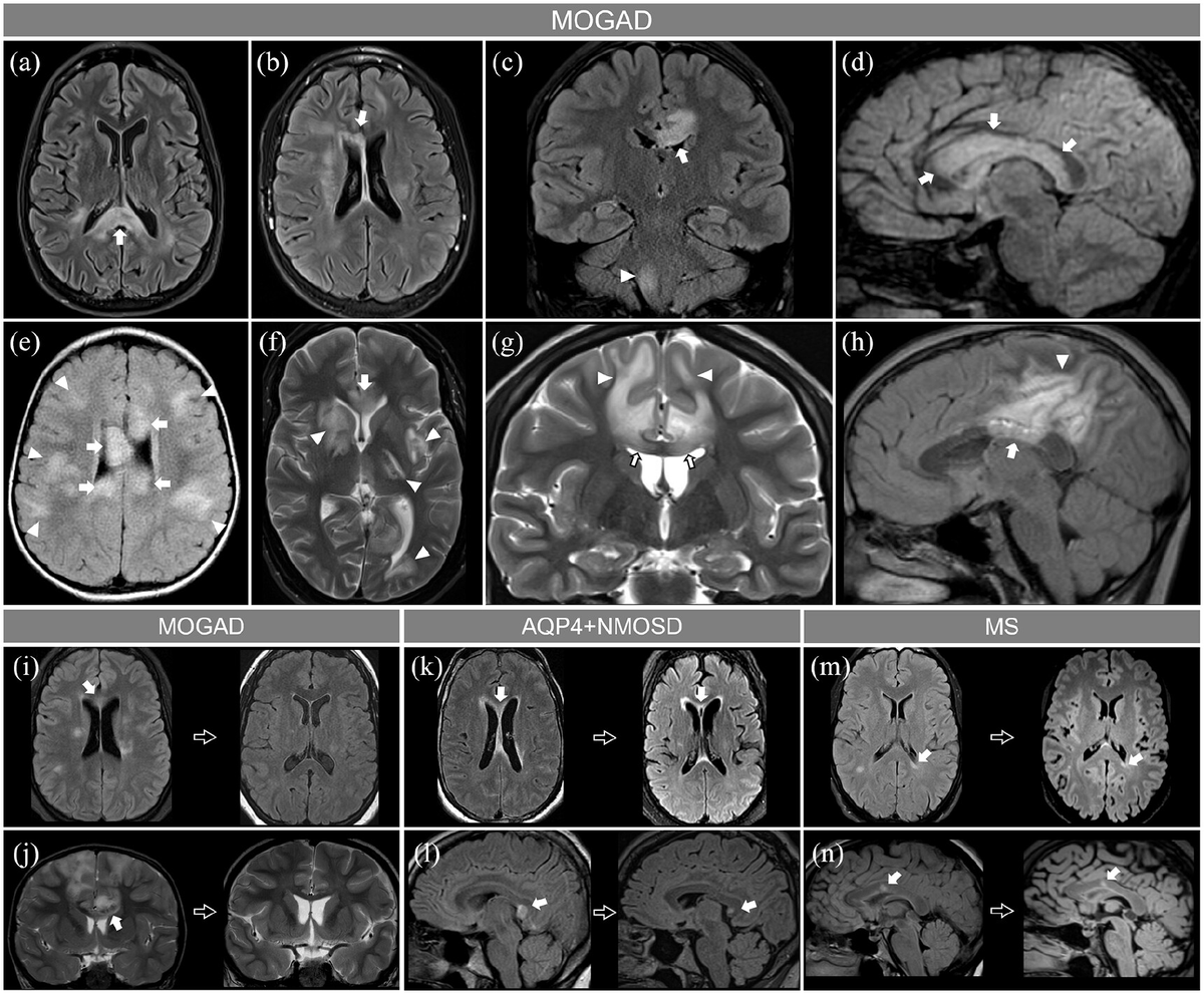 Dr. Brandon Beaber on Twitter "Corpus callosum involvement in