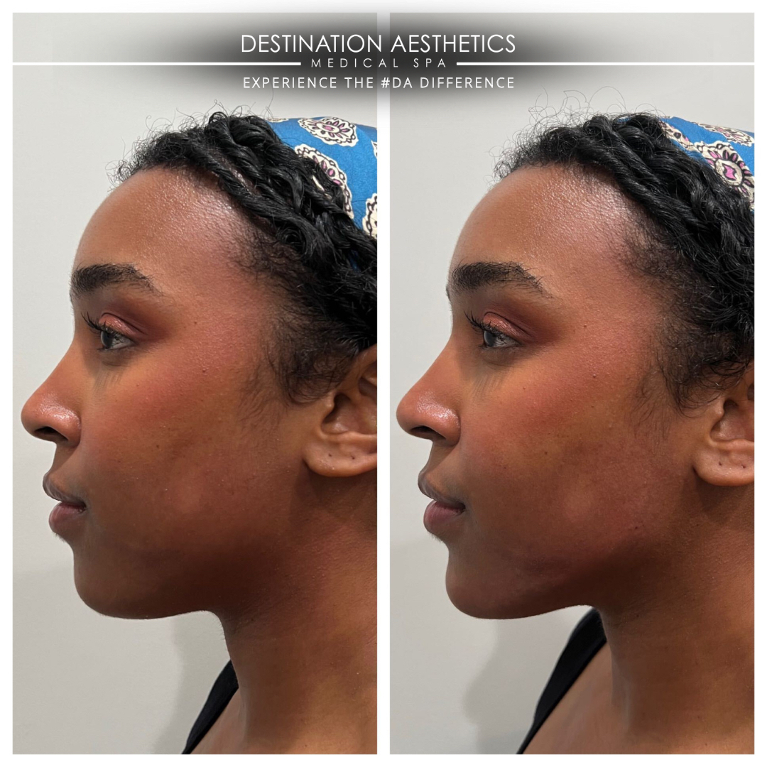 DestAesthetics's tweet photo. 4 syringes of Juvederm® Volux® XC for this beauty’s chin and jawline 💉🤩! Right now, you can get 4 syringes of @juvederm Volux® filler for $2,999 and get a FREE syringe of choice to complement ($1,101 value)! It is the ultimate package for those that want to get that sn https://t.co/l7pllhrL2d