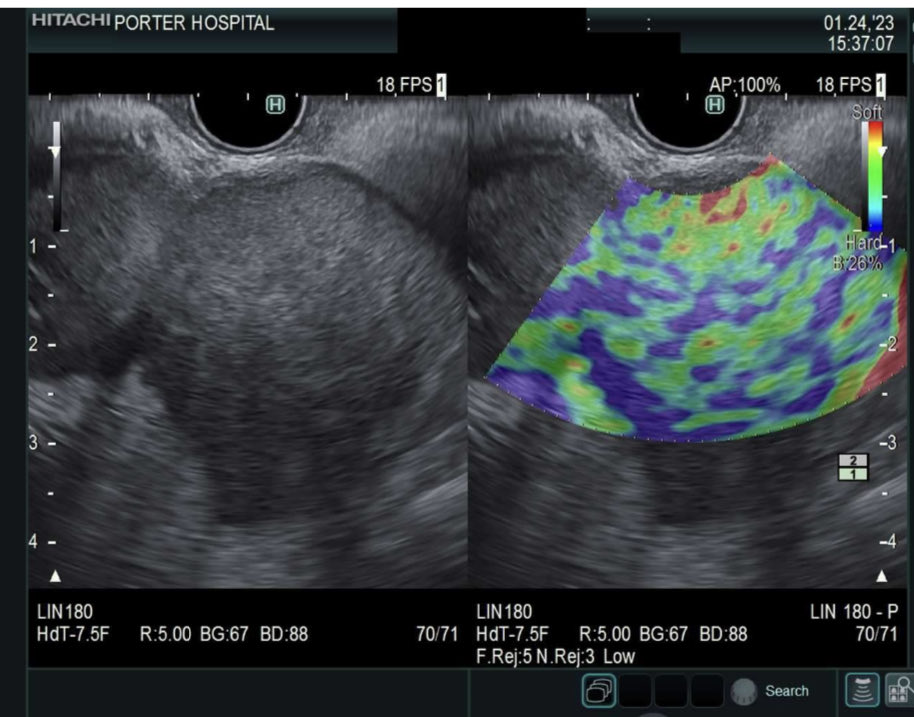 Very large left adrenal mass in elderly fmr smoker w LUL lung mass but neither accessible to bx by rad so pt referred to #InterventionalEndoscopy for #EUS FNB. Mixed pattern elasto.