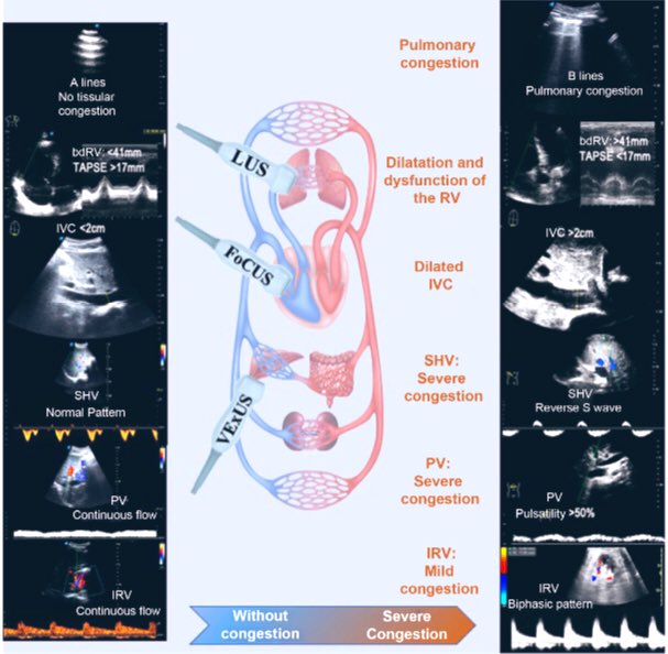 English version of our first article of the #PoCUS trilogy revistanefrologia.com//en-pocus-cong…