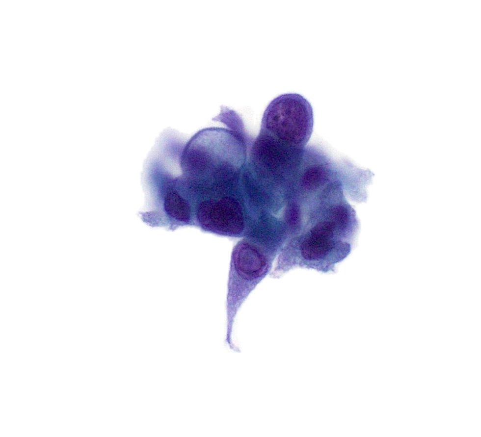 Thyroid FNA-Papillary thyroid carcinoma- tapering cytoplasmic 'tail' seen on ThinPrep is a cytomorphologic feature associated with tall cell variant.
#PathTwitter #cytopath #cytology #cytopathology #entpath