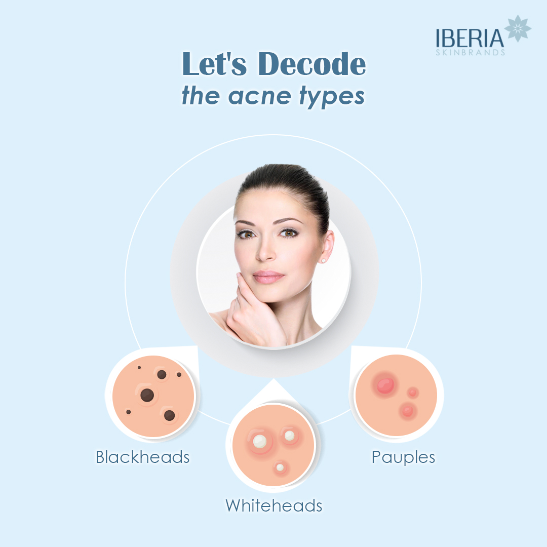 iberiaskinbran1's tweet photo. This wonderful post helps you to decode the types of acne effectively.
.
.
.
.
#IberiaSkinbrandsUK #SkincareDecodes #AcneTypes #AcneSolution #Blackheads #Whiteheads #Pauples #acnefree #smoothskin #skincareknowledge #Acne #FacialCare #AcneScares https://t.co/cFrxP35AWZ