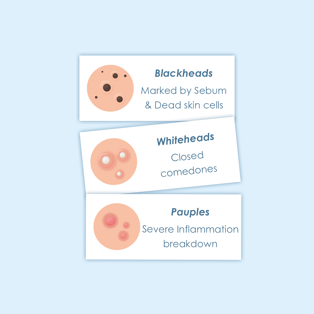 iberiaskinbran1's tweet photo. This wonderful post helps you to decode the types of acne effectively.
.
.
.
.
#IberiaSkinbrandsUK #SkincareDecodes #AcneTypes #AcneSolution #Blackheads #Whiteheads #Pauples #acnefree #smoothskin #skincareknowledge #Acne #FacialCare #AcneScares https://t.co/cFrxP35AWZ
