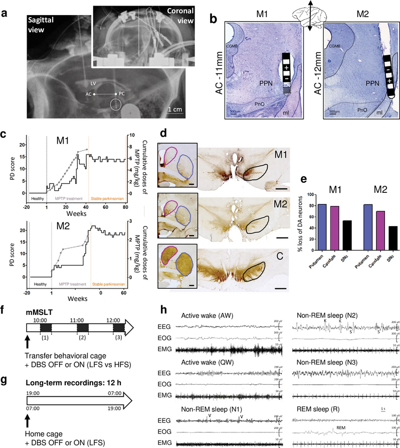 ScienceofPD's tweet photo. Excessive daytime sleepiness in a nonhuman primate model of #Parkinsons was improved by low-frequency stimulation of the pedunculopontine nucleus
https://t.co/pSKpo3nXCy https://t.co/EuOuq4JR2I