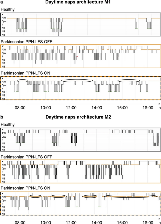 ScienceofPD's tweet photo. Excessive daytime sleepiness in a nonhuman primate model of #Parkinsons was improved by low-frequency stimulation of the pedunculopontine nucleus
https://t.co/pSKpo3nXCy https://t.co/EuOuq4JR2I