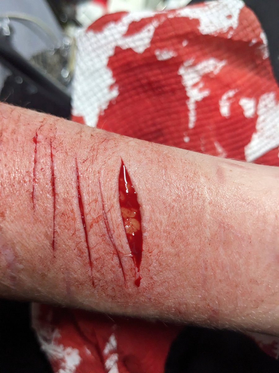 pagancals's tweet photo. tw//sh

first time hitting beans on my forearms im happy 

also please ignore how dirty the floor is I'm in my boyfriend's shed ://

🏷️ shtwt 988twt styrotwt beanstwt https://t.co/1nBu20FpXy