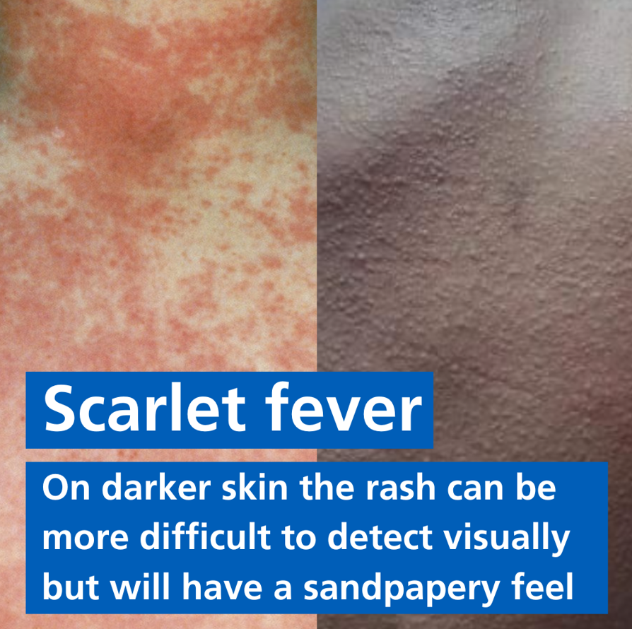 Useful graphic from @NHS_NCLICB about skin tone and feel when looking for signs of #ScarletFever @ZoeASargent @HillSchoolNurse @CamdenNCLICB @cnwlnhs @CNWLCAMHS @HillSchoolNurse @clchBrentHarrow