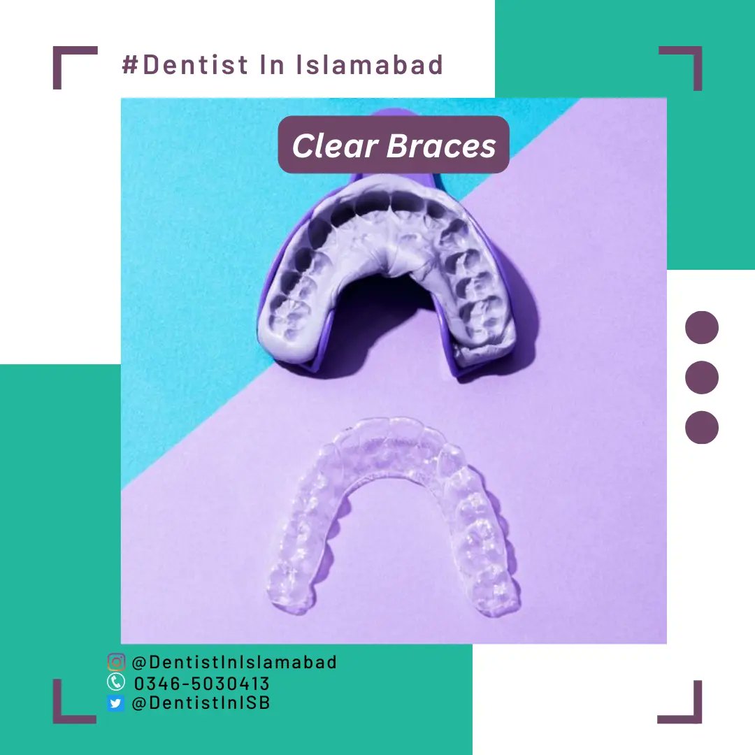 DentistInISB's tweet photo. Clear aligners/Clear braces
.
Aligners are thin, clear trays made to fit your teeth. Unlike metal braces, aligners are removable.
By appointment only
.
#Dentalimplants #Teethwhitening #Islamabad #islamabaddentist #Islamabadtoday #dentalcare #dentalblog https://t.co/69cyASGDYp