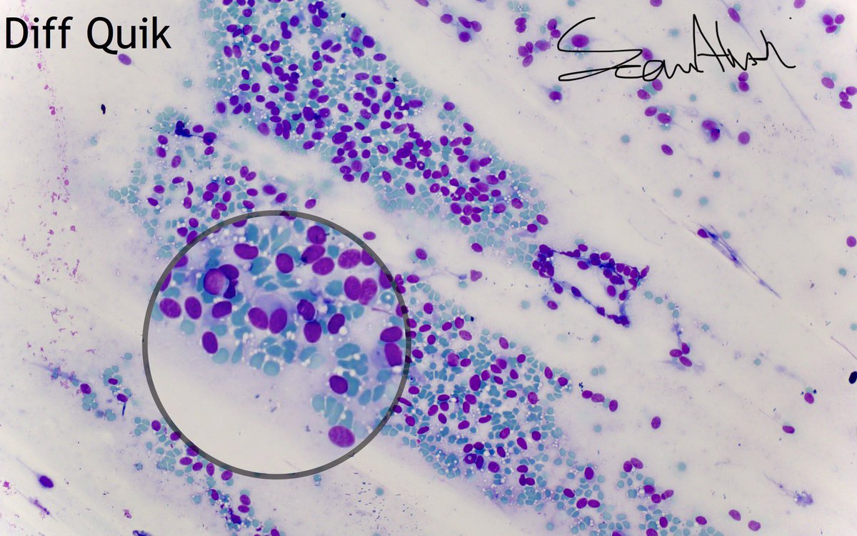 sam_albadri's tweet image. Cytology case for #pathology trainees. Lower lobe 🫁 mass FNA? Your Dx🔬@AzizaNassar2 @edusqo @aakasharmand @ZMaleki_cyto @SaudiCytopathol @DivaRSalomao @MelanieBoisMD @cytopathology @ekhanafshar @lara_pijuan @RoseannIWu @DrBuiPathology @VarshaManuchaMD @barkanga #cytopath