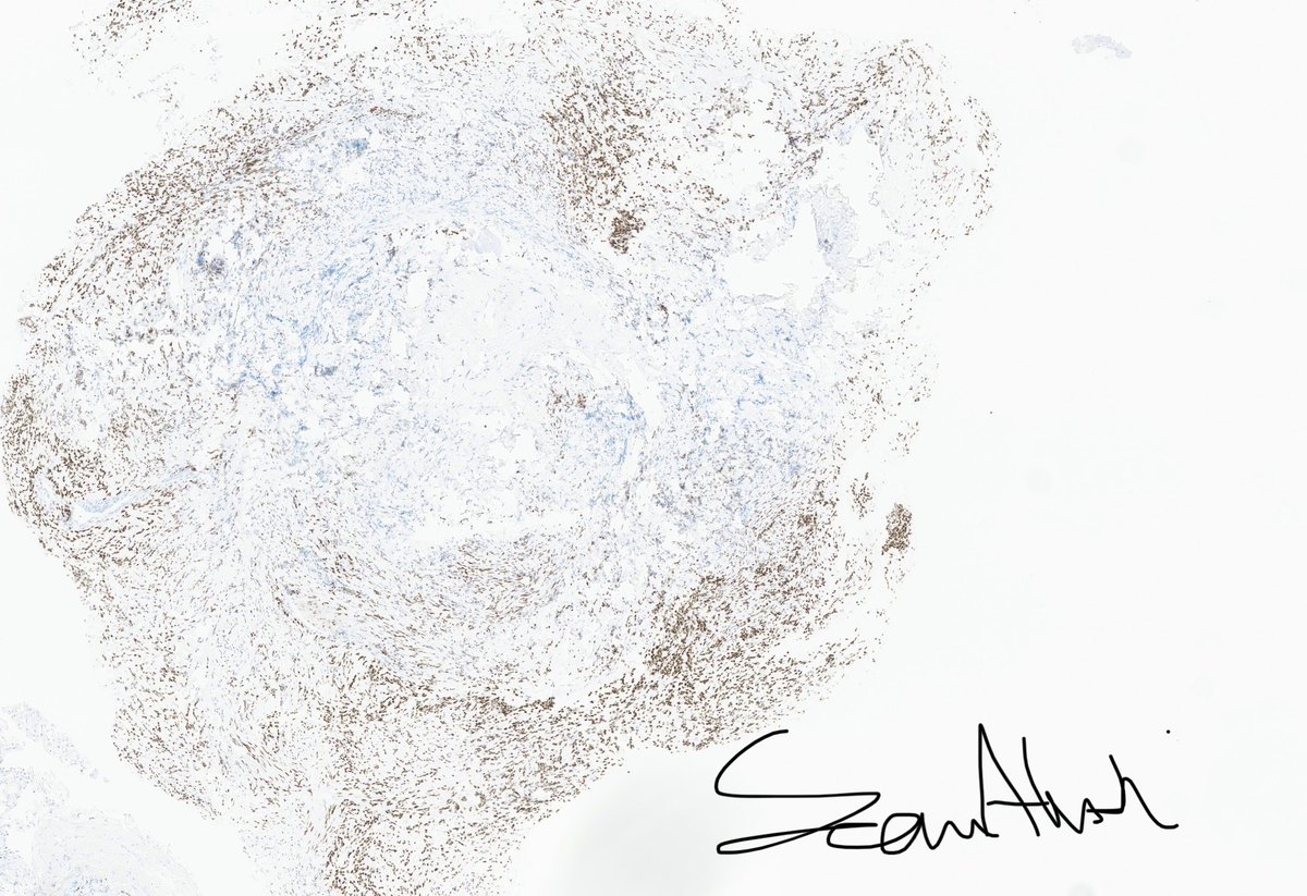 sam_albadri's tweet image. Cytology case for #pathology trainees. Lower lobe 🫁 mass FNA? Your Dx🔬@AzizaNassar2 @edusqo @aakasharmand @ZMaleki_cyto @SaudiCytopathol @DivaRSalomao @MelanieBoisMD @cytopathology @ekhanafshar @lara_pijuan @RoseannIWu @DrBuiPathology @VarshaManuchaMD @barkanga #cytopath