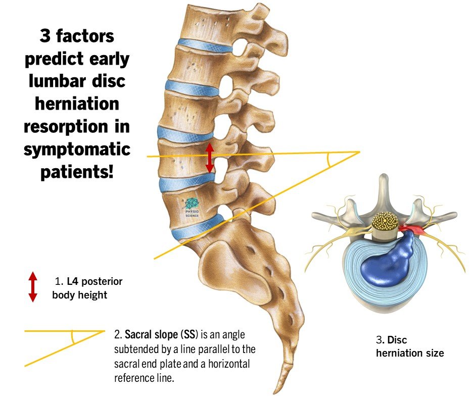 PhysioMeScience's tweet photo. Just published in “The Spine Journal” 🔥

Can we predict resorption of lumbar disc herniations in symptomatic patients? 

https://t.co/kSePRv2x7k https://t.co/srPa6vnD3h