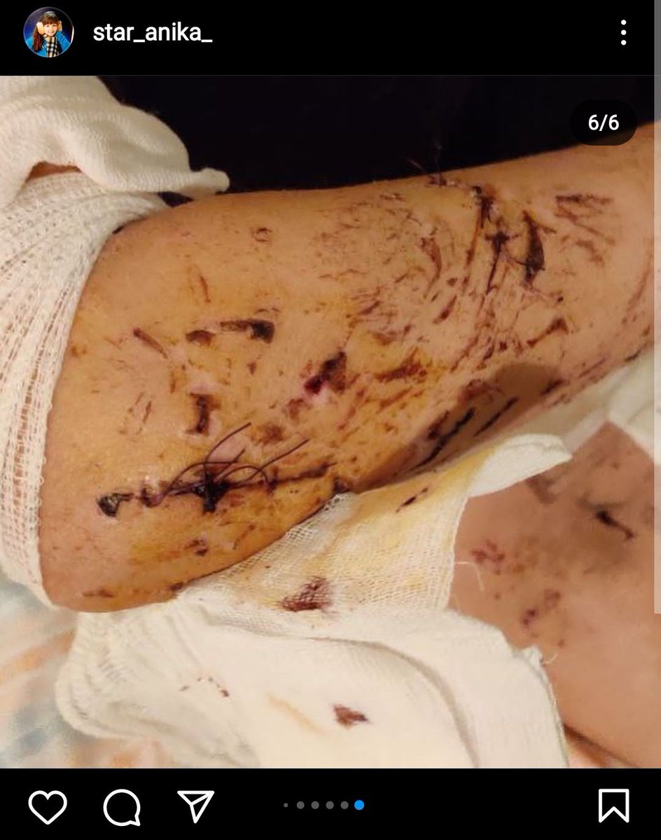 ❗ПОТРІБНА ДОПОМОГА❗

Анні Котовій, дівчинці, що втекла із Сєвєродонецька та стала жертвою ракетного обстрілу Дніпра 14.01, відмовили у безкоштовному лікуванні у Польщі. Її чекають операції з видалення скла з тіла та обличчя, протезування ока та встановлення пластини в черепі