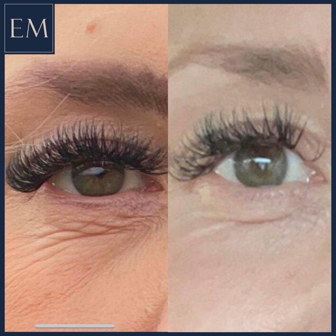 ElementsMedica1's tweet photo. Patient selfie! This patient took a photo in her car before coming to have her first LaseMD treatment, and another two weeks post treatment. 
As you can see the lines under her eyes have VASTLY improved. Phone 01302 343432 to book. https://t.co/60NxfxUh3R