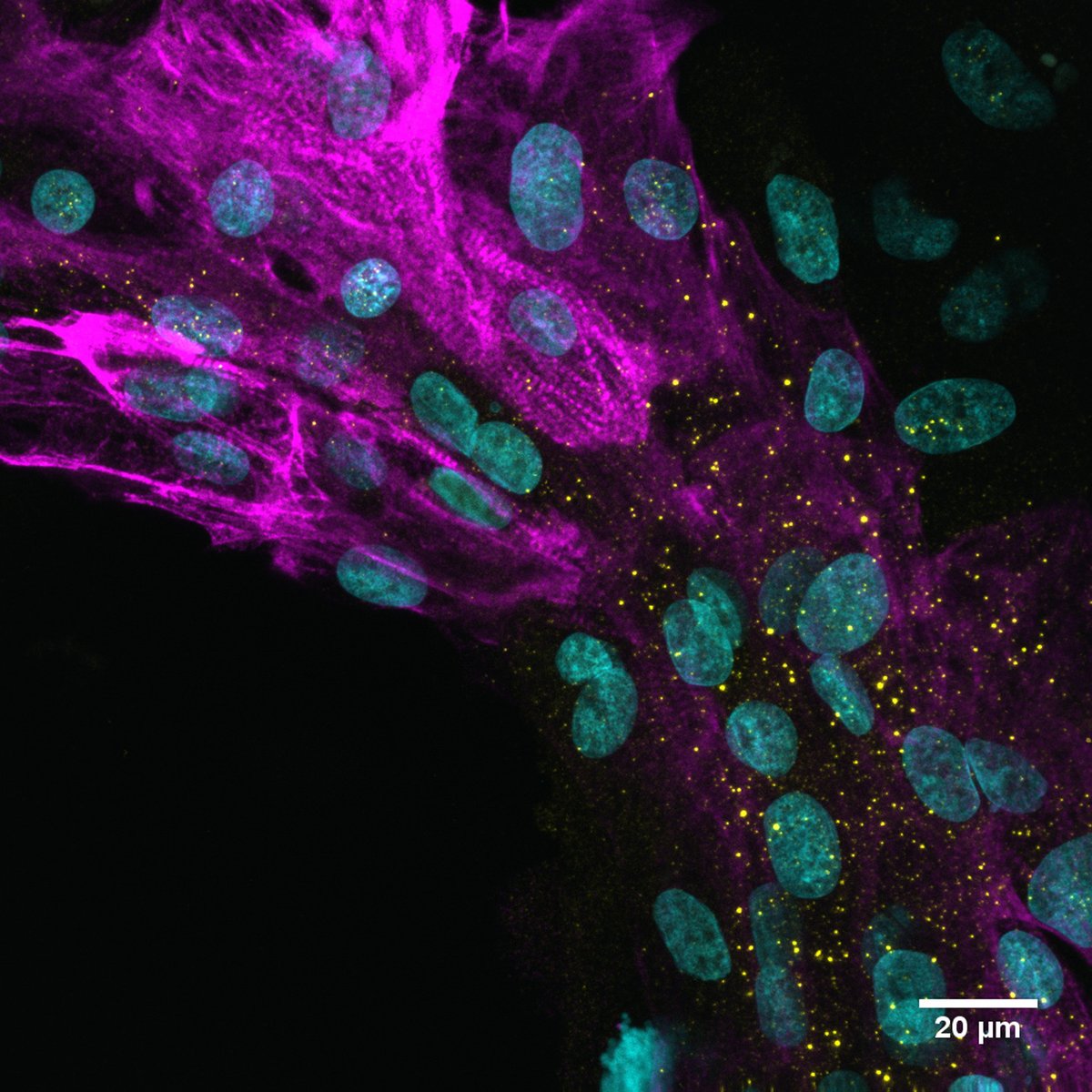 Forschende des <a href="/UniklinikUlm/">Uniklinik Ulm</a> haben untersucht, wie pathogen #SARSCoV2 (Sub-)Varianten🦠auf Herzmuskelzellen🫀 wirken. Ergebnis: Die aktuelle #Omicron Subvariante BA.5 wirkt ähnlich zellschädigend wie Delta. t1p.de/Omicron *wt/Abb. #SigTransductTargetTher #uulm