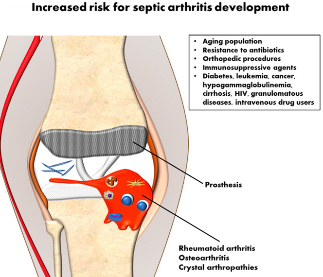 USMLEStepStudy's tweet photo. Septic arthritis - Joint space infection, MC bacteria (Staph aureus, Strept spp., N. gonorrhoeae); hematogenous spread or direct inoculation (trauma or surgery); s/s: pain/swelling, warmth, ↓ROM; Dx: CBC w/diff &amp; synovial fluid analysis; Rx: IV &amp; PO antibx up to 6 wks, I&amp;D https://t.co/QWJPBidWiY
