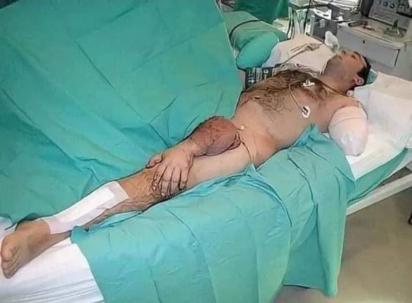 ผู้ชายคนนี้สูญเสียแขนไปในอุบัติเหตุ แต่เนื่องจากเนื้อเยื่อได้รับความเสียหายแพทย์จึงไม่สามารถติดกลับเข้าไปได้ทันที เลยนำไปเย็บติดที่ต้นขาเพื่อให้เลือดไหลเวียน และสามารถผ่าตัดเอาแขนต่อกลับเข้าไปใหม่ได้สำเร็จในเวลาต่อมา