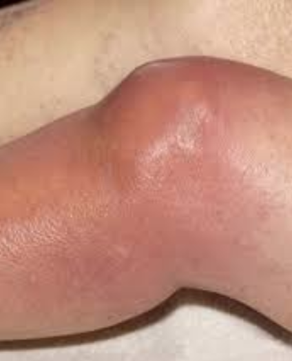 USMLEStepStudy's tweet photo. Septic arthritis - Joint space infection, MC bacteria (Staph aureus, Strept spp., N. gonorrhoeae); hematogenous spread or direct inoculation (trauma or surgery); s/s: pain/swelling, warmth, ↓ROM; Dx: CBC w/diff &amp; synovial fluid analysis; Rx: IV &amp; PO antibx up to 6 wks, I&amp;D https://t.co/QWJPBidWiY