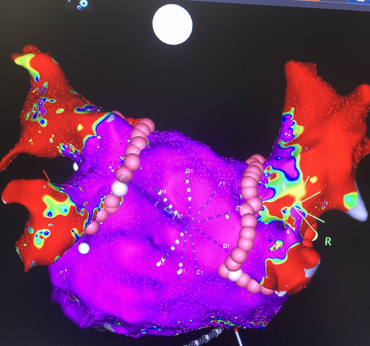 Fantastic day at the EP-lab @AUHdk @auhcardio using Octaray during #afablation in patient with persisting #AFib #carto3 #epeeps @DocAsger Comments? @NStoettrup