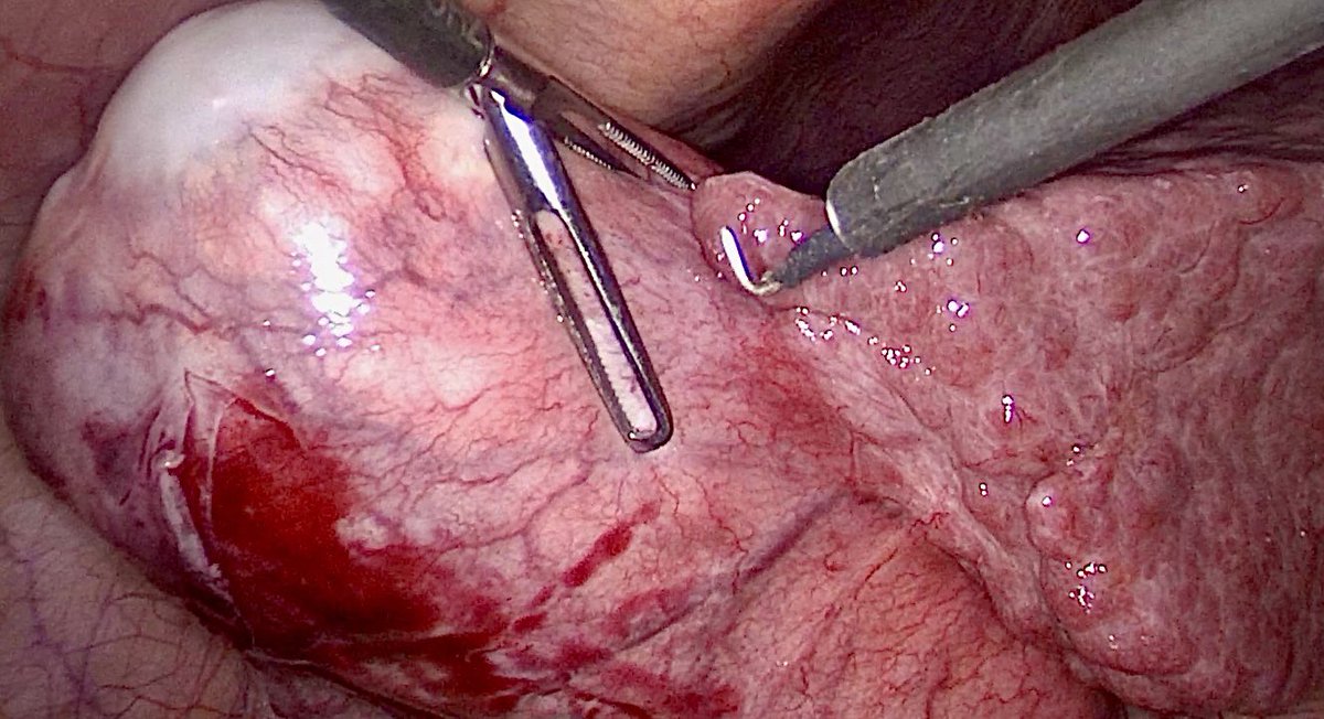 Hassaan Bari (@dr_hassaanbari) on Twitter photo WWYD;
52👧 Hep C, BMI 33
⬇️Plt 83k, INR 1.5, LFT ✅
CT: GB Ca with Cirrhotic Liver🤓
Intraop:
Varicosities!
Tx on peritoneal site
🚫liver invasion
Cystic duct margin -ve on FS
Will you do liver bed resection?🙃
<a href="/IHPBA/">IHPBA</a> <a href="/SOS_Pk/">Surgical Oncology Society Pakistan. SOSPK</a> <a href="/hpb_so/">SoMe4HPB</a> <a href="/HpbLounge/">HPB Lounge</a>
#Cancers #surgeons #MedEd #liver WWYD;
52👧 Hep C, BMI 33
⬇️Plt 83k, INR 1.5, LFT ✅
CT: GB Ca with Cirrhotic Liver🤓
Intraop:
Varicosities!
Tx on peritoneal site
🚫liver invasion
Cystic duct margin -ve on FS
Will you do liver bed resection?🙃
<a href="/IHPBA/">IHPBA</a> <a href="/SOS_Pk/">Surgical Oncology Society Pakistan. SOSPK</a> <a href="/hpb_so/">SoMe4HPB</a> <a href="/HpbLounge/">HPB Lounge</a>
#Cancers #surgeons #MedEd #liver