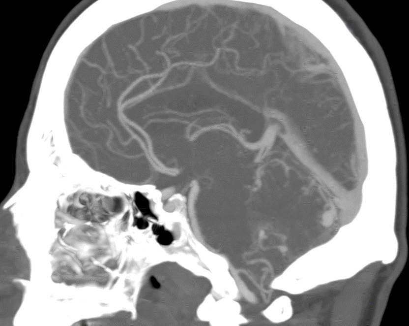 1. 
Medical H: 60 y.o, smoker and Hypertension. Symptoms: Thunderclap headache, nausea and vomiting. 
Ph Exam: GCS 15, no motor or sensory deficit.
CT + angio CT: Acute IV ventricle bleeding + cerebellar AVM + 2 PICA flow aneurysms.
Options? Keep reading
<a href="/FuatArikan/">Fuat Arikan</a> <a href="/vallhebron/">Vall d'Hebron</a>