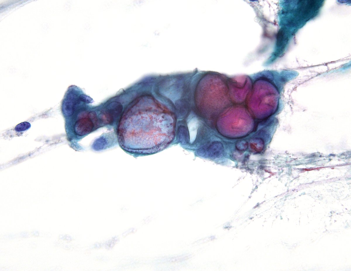 Distended, pleomorphic and irregularly distributed intracytoplasmic mucin vacuoles, a frequently under-recognized feature of 'Pancreatic Ductal Adenocarcinoma' (FNA)