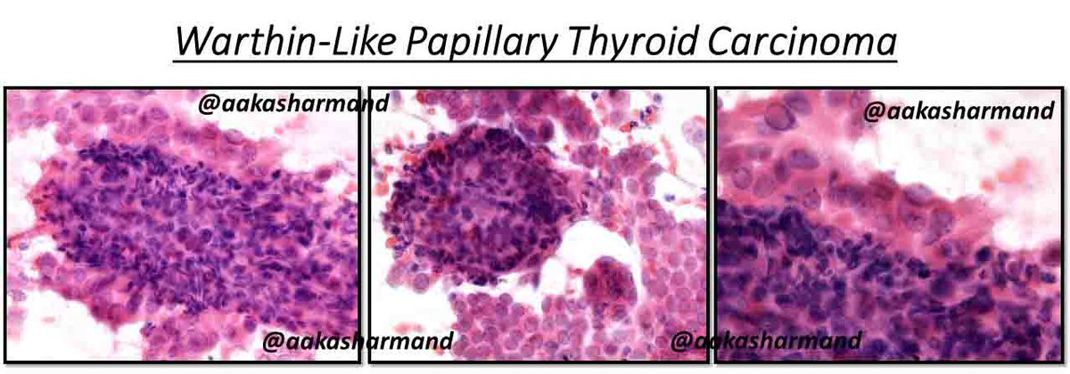 aakasharmand's tweet photo. @MariaGoobs @itondiresta @MariaGoobs photobombing w a cyto-case of Warthin-like subtype of PTC @PennPathLabMed @KMirza @sza_jhcyto @DrJuhlin @PoonamVohra3 @Baskotacytopath @IvanaKholova @DiagnosticCyto @EndoPath @itondiresta @PathDocBoston @GokozanMD @MarcosLepeMD https://t.co/hjqrO9etz4