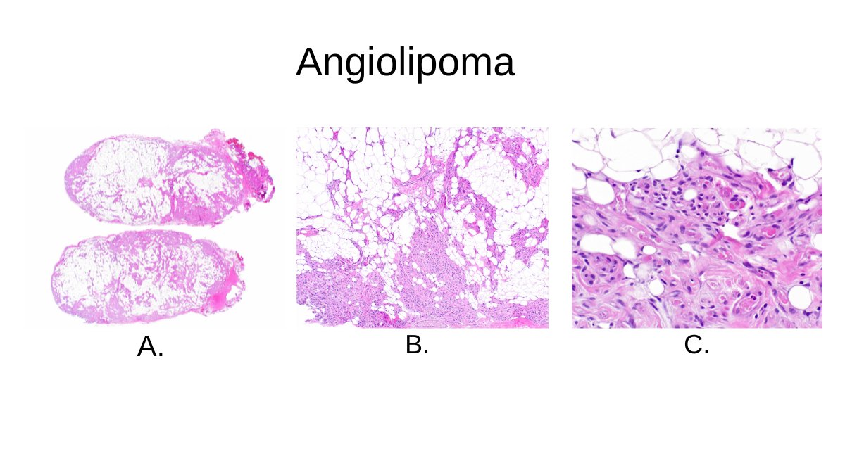 This is a beautiful example of an angiolipoma. Note the characteristic fibrin thrombi. #CaseoftheWeek #PathTwitter