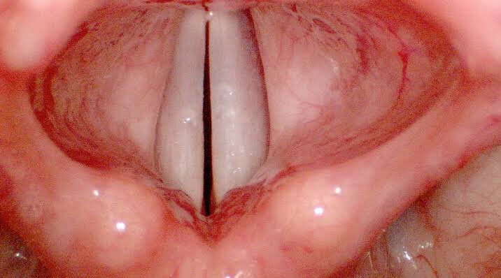 DatosDentista's tweet photo. Así se ven las cuerdas vocales. https://t.co/AkTb7uOeNr